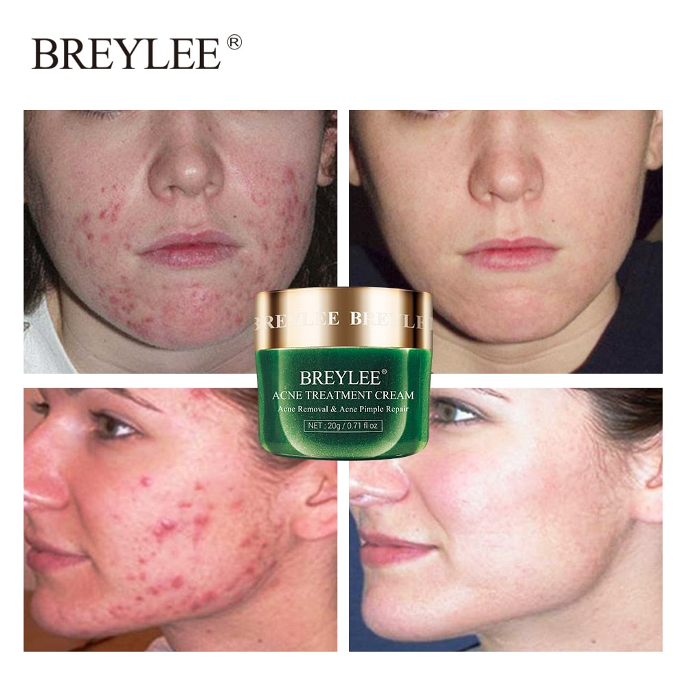 BREYLEE Acne Pimple Patch Acne Treatment Serum Face Sheet Mask Facial Acne Cream Essence Facial Skin Care Pimple Remover Tools