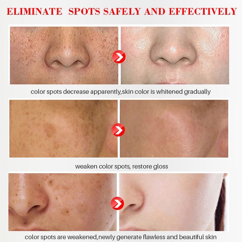 10PCS Whitening Freckle Serum Brighten Remove Dark Spot Fade Pigment Melanin Correcting Facial Essence Skin Care Korea Comestic