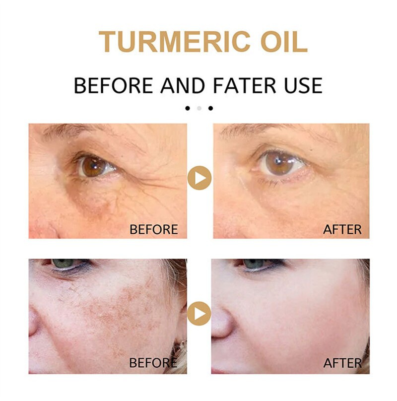 Turmeric Freckle Whitening Serum Fade Dark Spot Removal Pigment Melanin Correcting Facial Essence Beauty Face Skin Care 30ml