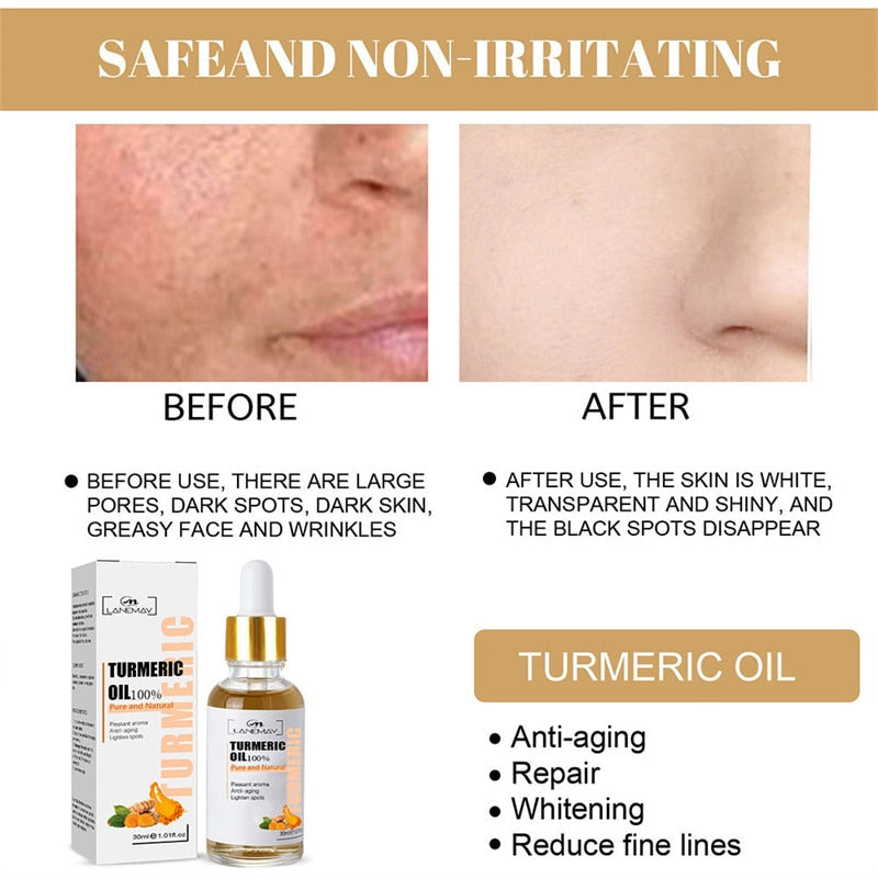 Turmeric Freckle Whitening Serum Fade Dark Spot Removal Pigment Melanin Correcting Facial Essence Beauty Face Skin Care 30ml