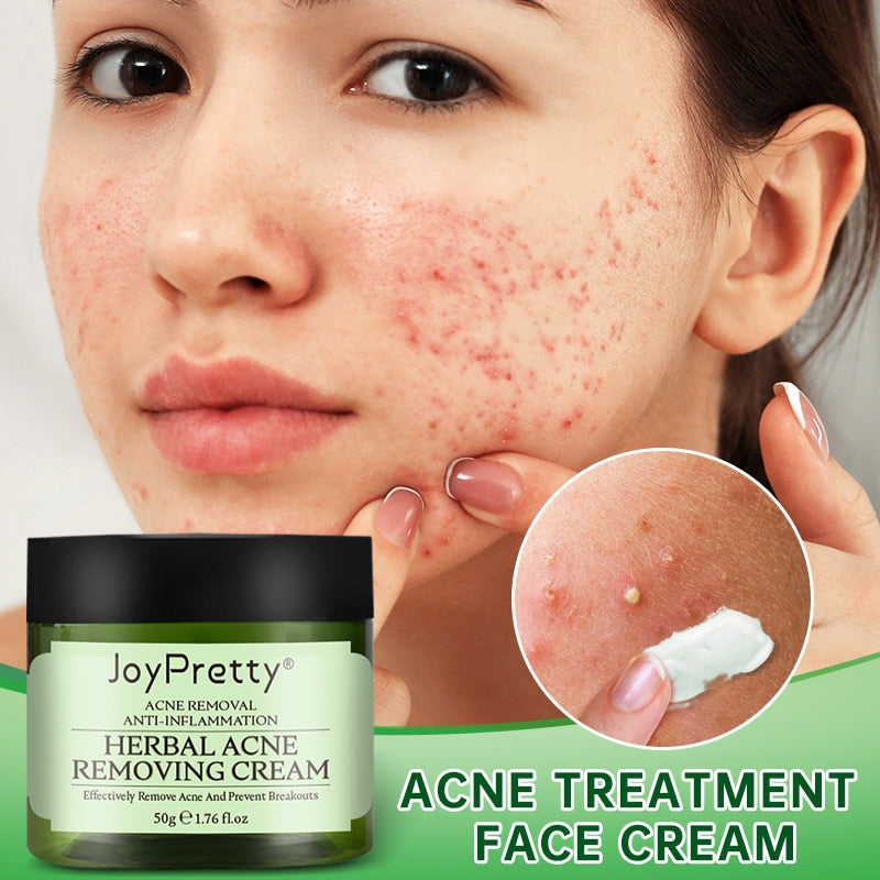 JoyPretty Acne Face Cream Herbal Pimple Scar Removal Shrink Pore Oil Control Moisturizing Facial Cream Acne Treatment Skin Care